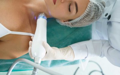 Microneedling Behandlung – RF Microneedling